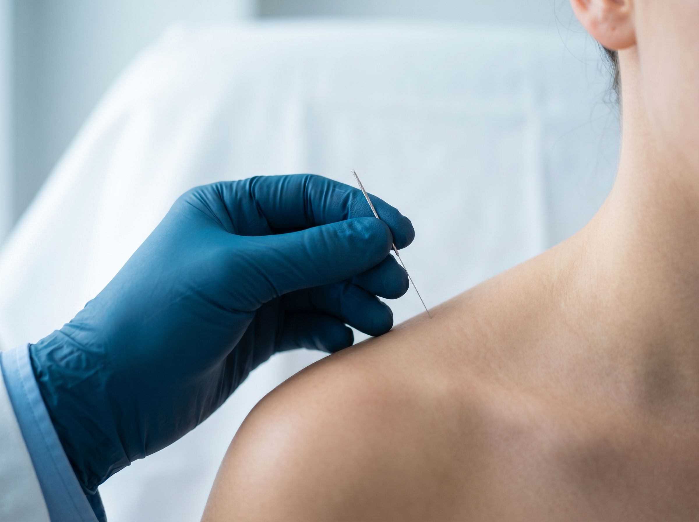 Tangan ber-glove biru menempatkan jarum tipis untuk dry needling di bahu pasien — tanpa wajah terlihat